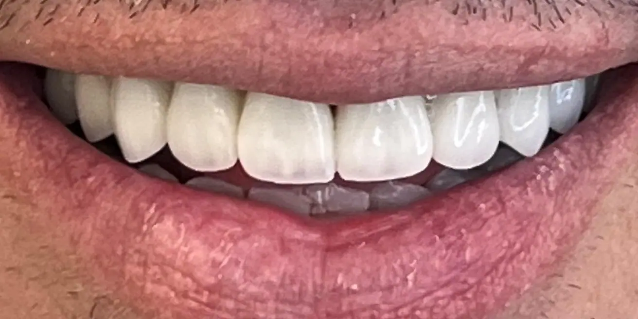 After: From metal-ceramic bridges to zirconia crowns