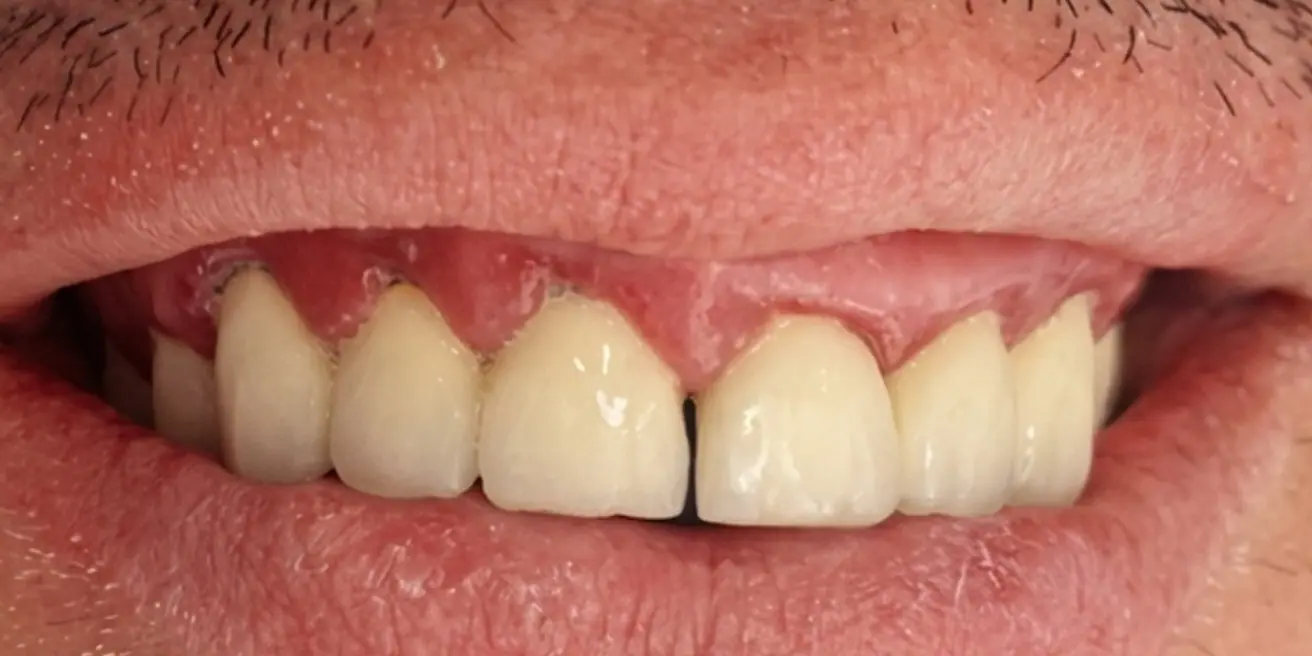 Before: From metal-ceramic bridges to zirconia crowns