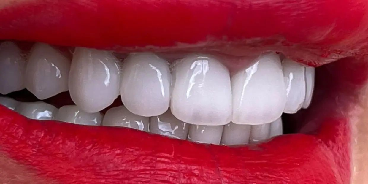 After: From old crowns to a new smile