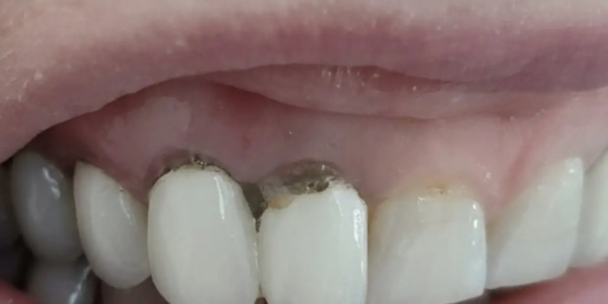 Before: From old crowns to a new smile