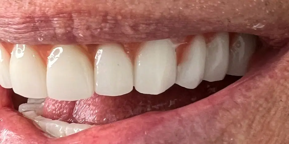 After: Implant rehabilitation