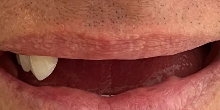 Before: Implant rehabilitation