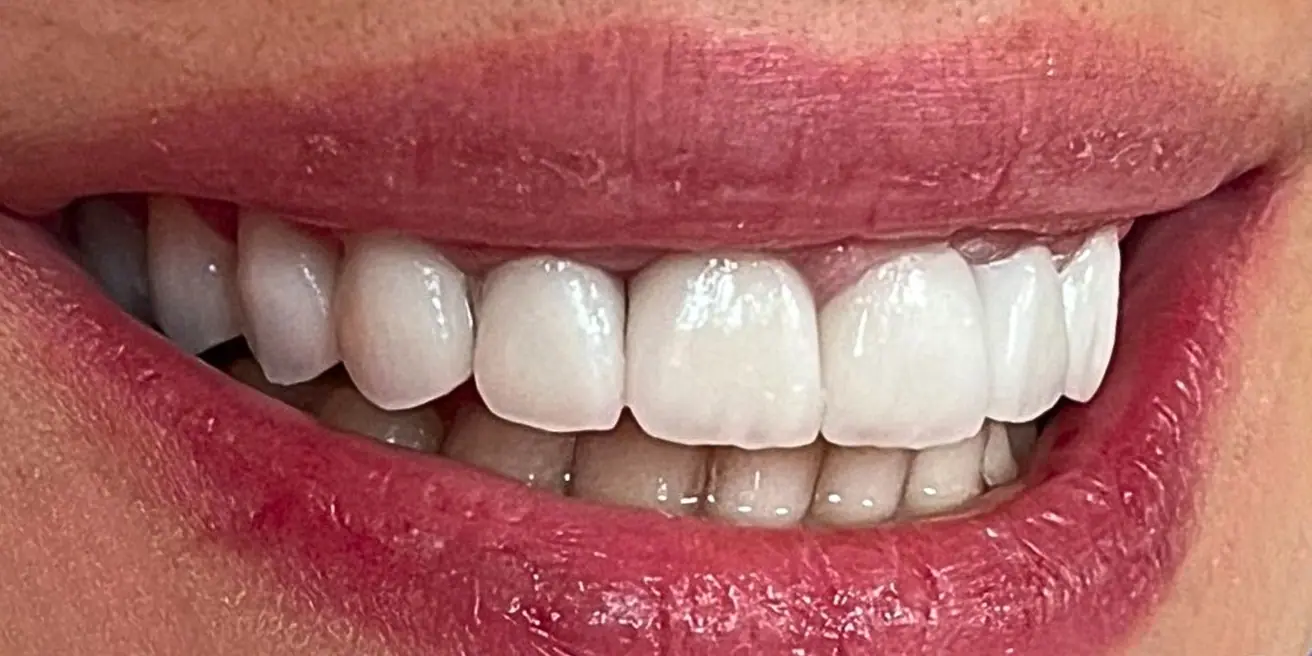 After: Upper jaw in zirconia