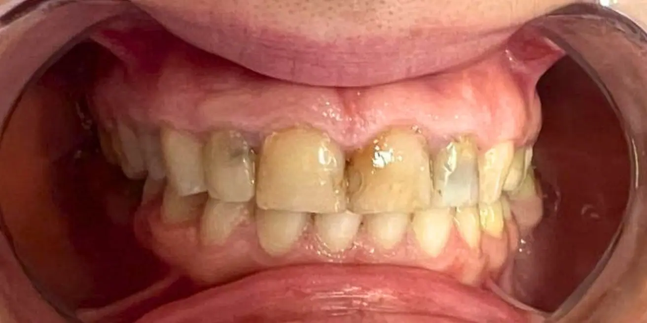 Before: Upper jaw in zirconia