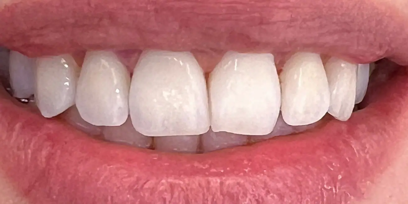 After: Professional whitening with BEYOND® II