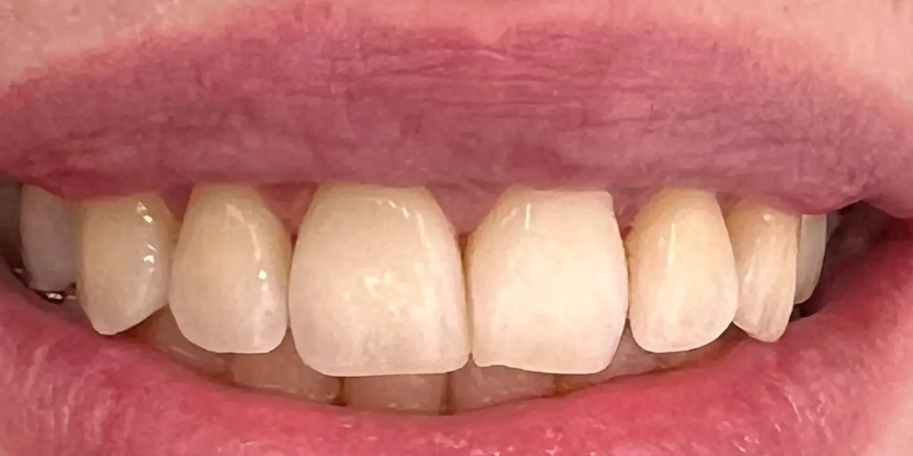 Before: Professional whitening with BEYOND® II